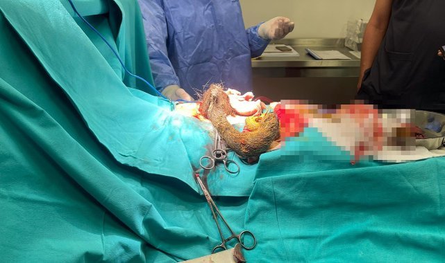 14 Yaşındaki Kızın Midesinde 3.5 Kiloluk Kıl Yumruğu